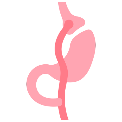 Bariatric Surgery - Gastric Bypass Illustration